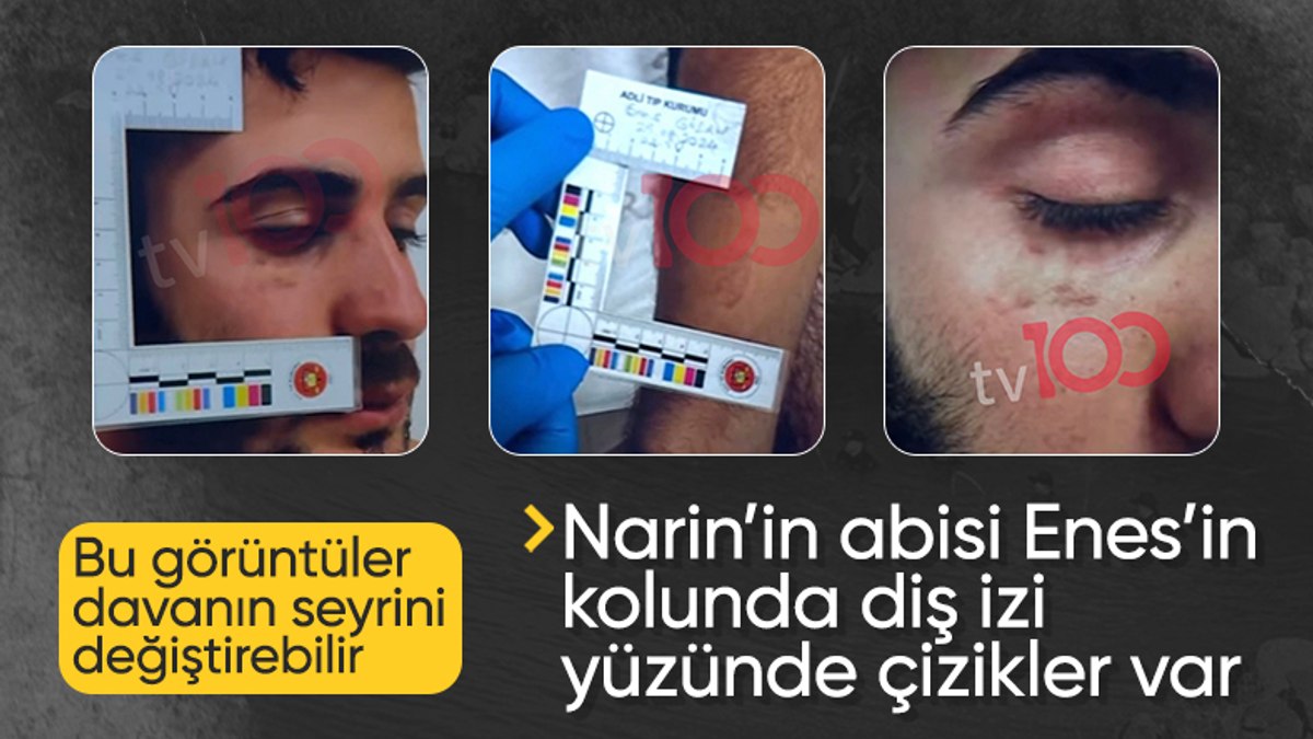 Narin davasının seyri değişecek: Enes Güran’ın kolunda diş, yüzünde çizikler var