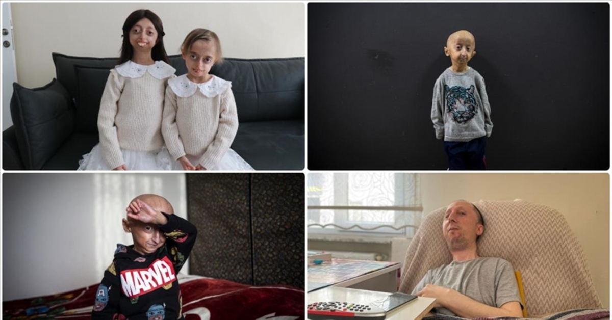 Dünya genelinde yaklaşık 400 milyon insan nadir hastalıklarla mücadele ediyor